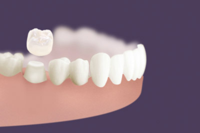 dental crowns and veneers