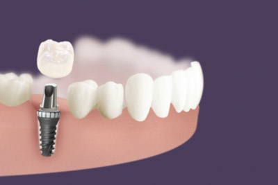 Dental implants and crowns
