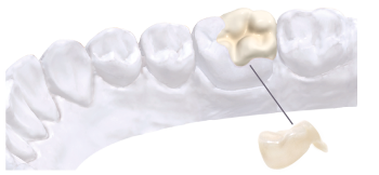 Ceramic inlays dental