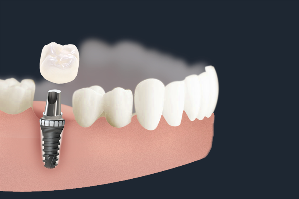Restoration of teeth with help of dental implants